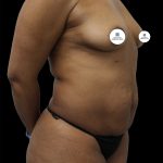 Mommy Makeover Before & After Patient #2631