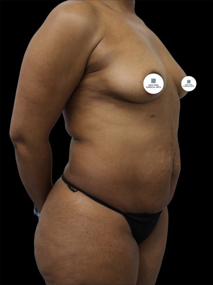 Mommy Makeover Before & After Patient #2631