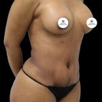 Mommy Makeover Before & After Patient #2631