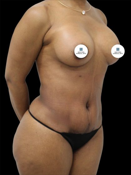 Mommy Makeover Before & After Patient #2631