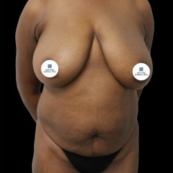 Mommy Makeover Before & After Patient #2632