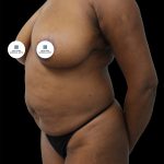 Mommy Makeover Before & After Patient #2632