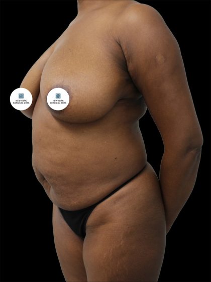 Mommy Makeover Before & After Patient #2632