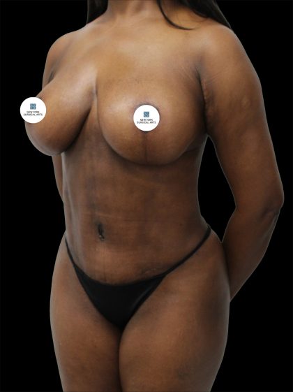 Mommy Makeover Before & After Patient #2632
