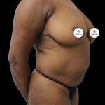 Mommy Makeover Before & After Patient #2632