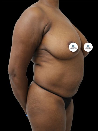 Mommy Makeover Before & After Patient #2632
