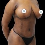 Mommy Makeover Before & After Patient #2632