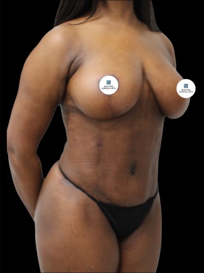 Mommy Makeover Before & After Patient #2632
