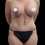 Mommy Makeover Before & After Patient #2633