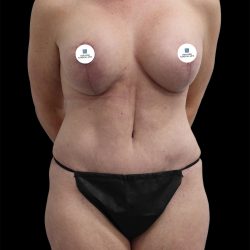 Mommy Makeover Before & After Patient #2633
