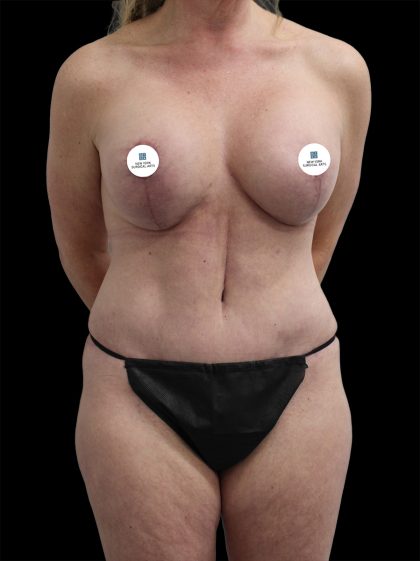 Mommy Makeover Before & After Patient #2633