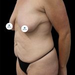 Mommy Makeover Before & After Patient #2633