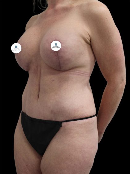Mommy Makeover Before & After Patient #2633