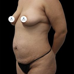Mommy Makeover Before & After Patient #2635