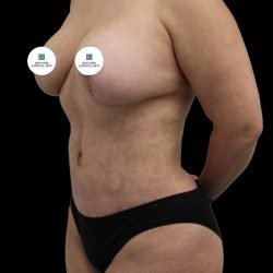 Mommy Makeover Before & After Patient #2635