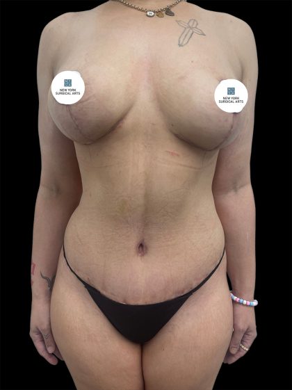Mommy Makeover Before & After Patient #2636