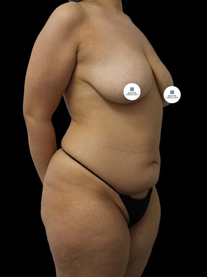 Mommy Makeover Before & After Patient #2636