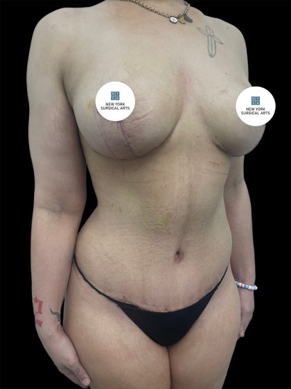 Mommy Makeover Before & After Patient #2636