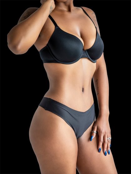 Tummy Tuck Before & After Patient #2687