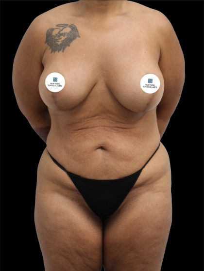 Tummy Tuck Before & After Patient #2696