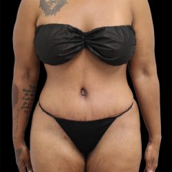 Tummy Tuck Before & After Patient #2696