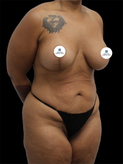 Tummy Tuck Before & After Patient #2696