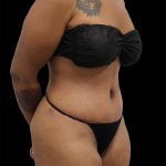 Tummy Tuck Before & After Patient #2696