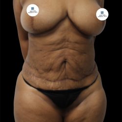 Tummy Tuck Before & After Patient #2740