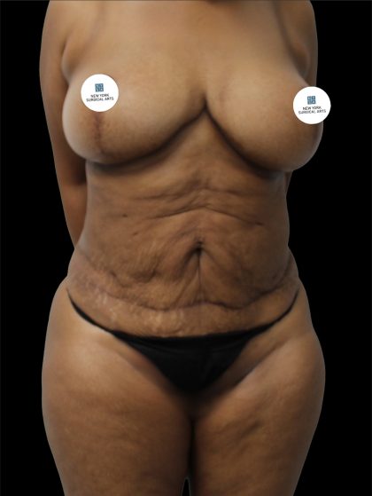 Tummy Tuck Before & After Patient #2740