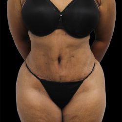 Tummy Tuck Before & After Patient #2740