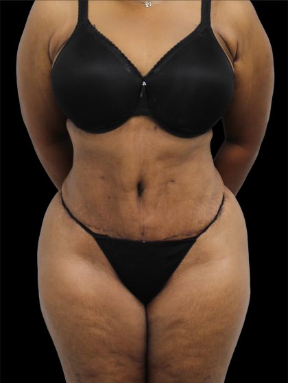 Tummy Tuck Before & After Patient #2740