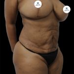 Tummy Tuck Before & After Patient #2740