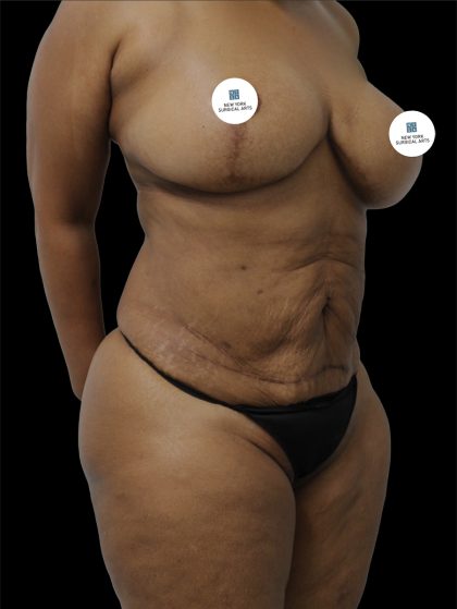 Tummy Tuck Before & After Patient #2740