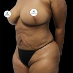 Tummy Tuck Before & After Patient #2740