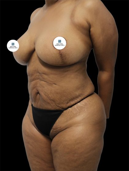 Tummy Tuck Before & After Patient #2740