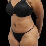 Tummy Tuck Before & After Patient #2740