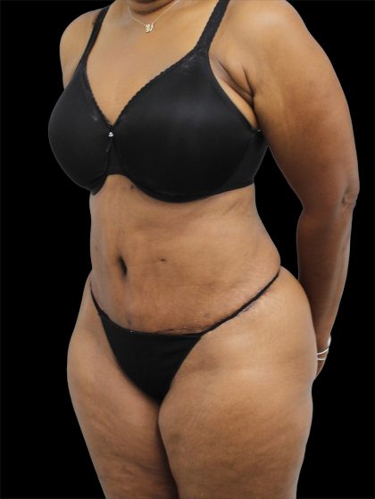 Tummy Tuck Before & After Patient #2740