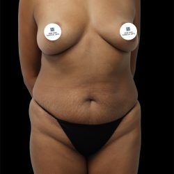 Tummy Tuck Before & After Patient #2741