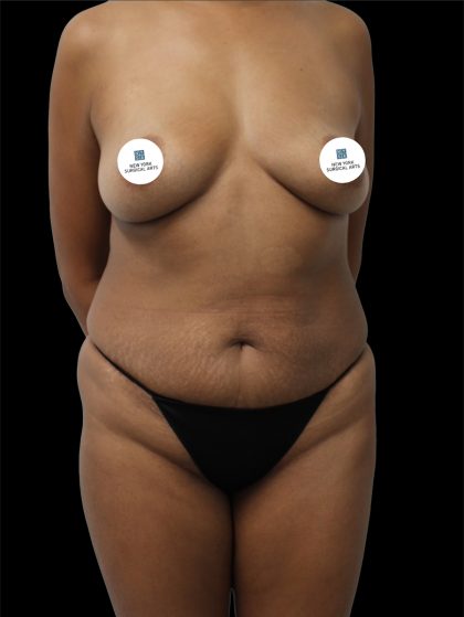 Tummy Tuck Before & After Patient #2741