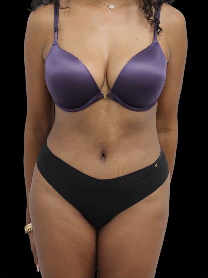 Tummy Tuck Before & After Patient #2741