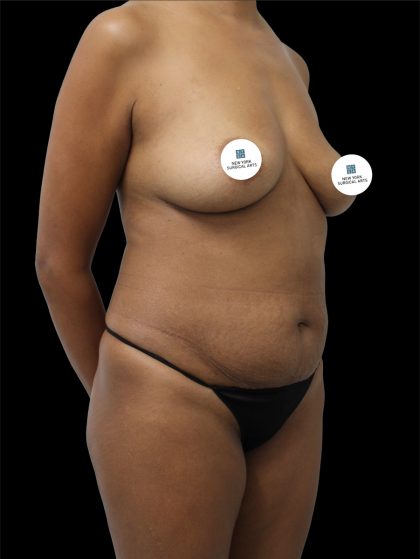 Tummy Tuck Before & After Patient #2741