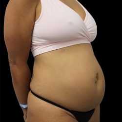 Tummy Tuck Before & After Patient #2742