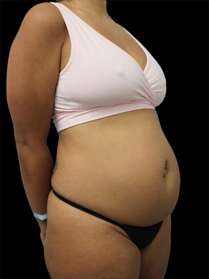 Tummy Tuck Before & After Patient #2742