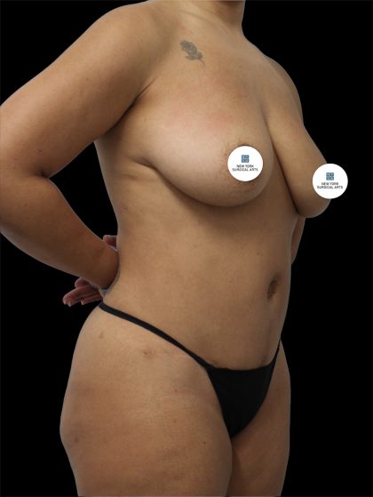 Tummy Tuck Before & After Patient #2742
