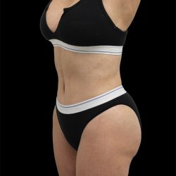 Tummy Tuck Before & After Patient #2743