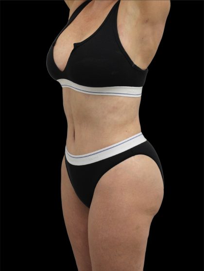 Tummy Tuck Before & After Patient #2743