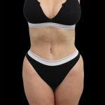 Tummy Tuck Before & After Patient #2743