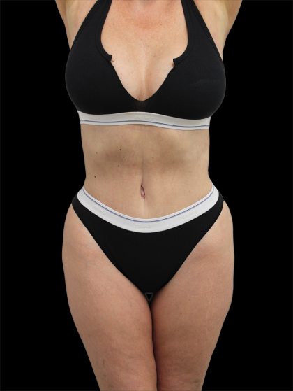Tummy Tuck Before & After Patient #2743