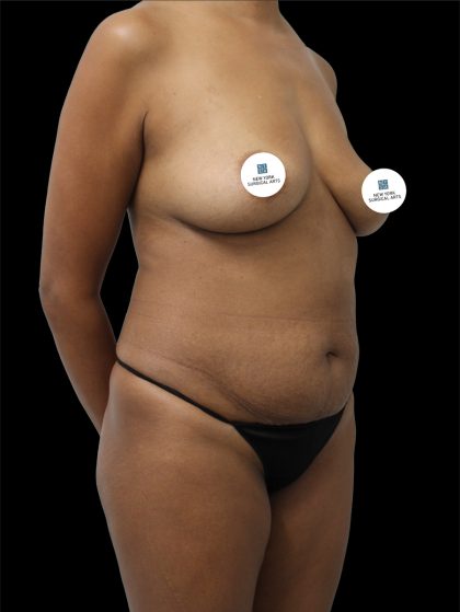 Tummy Tuck Before & After Patient #2744