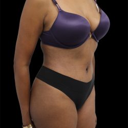 Tummy Tuck Before & After Patient #2744